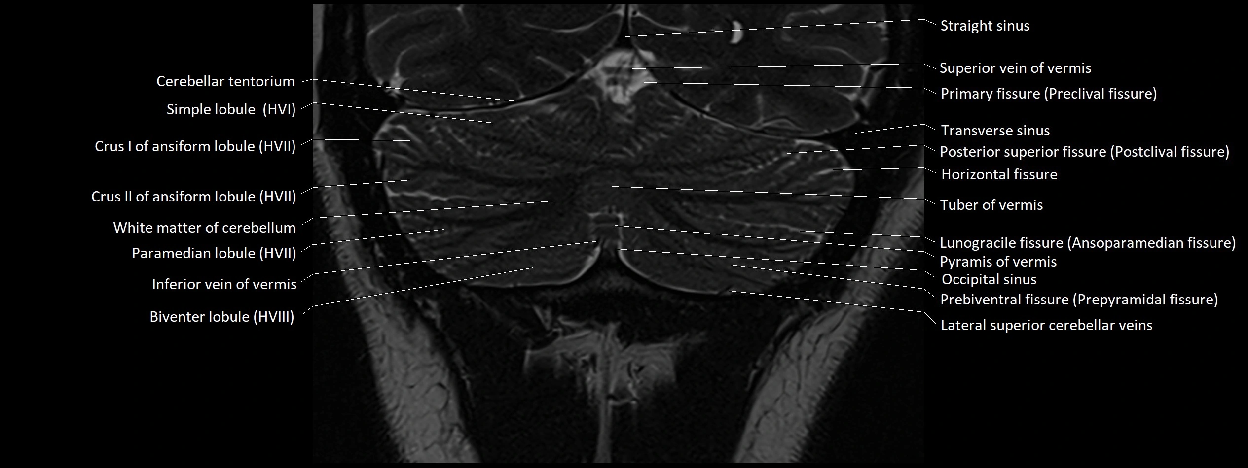 Anatomy of cerebellum coronal cross sectional 3T image 22.webp